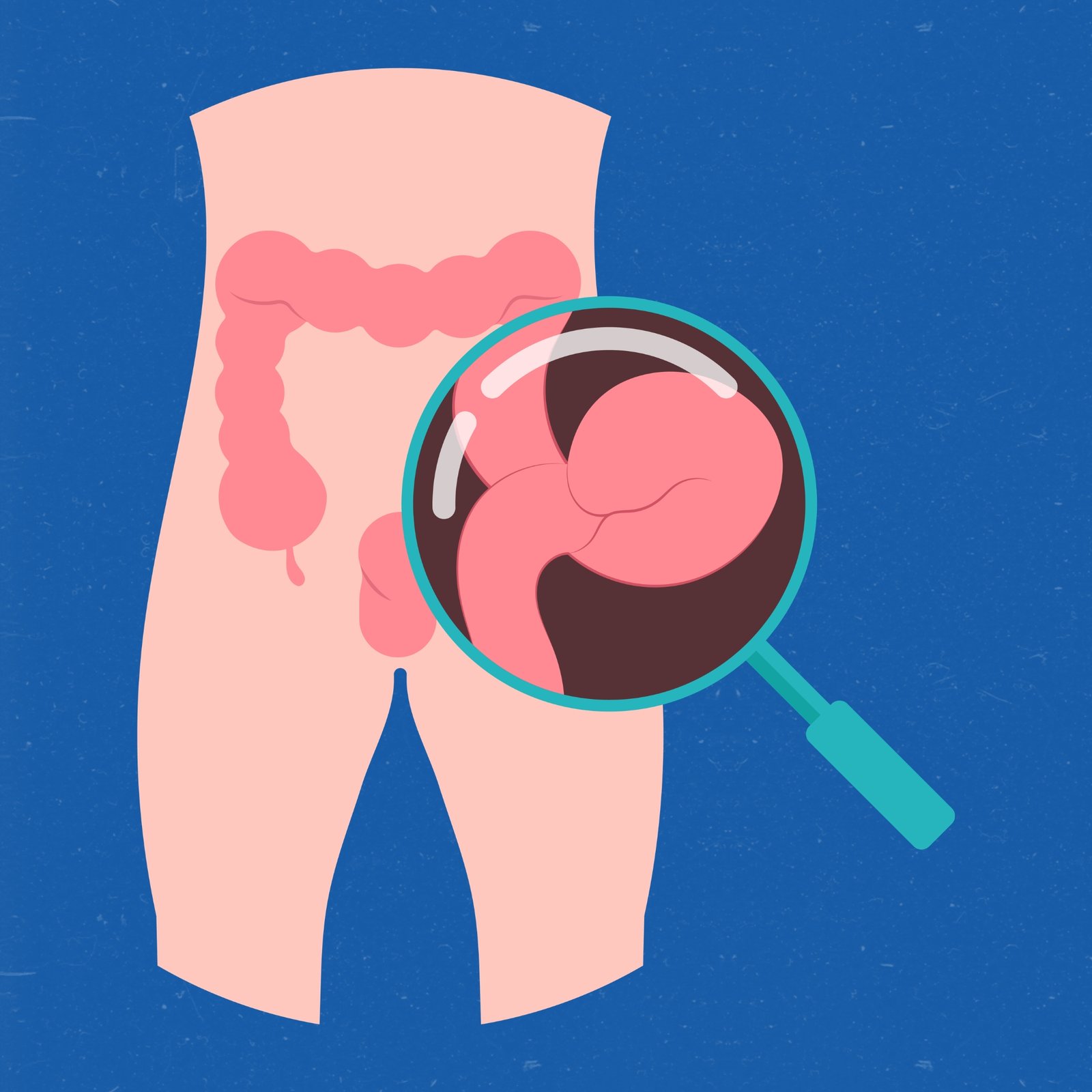 hernias