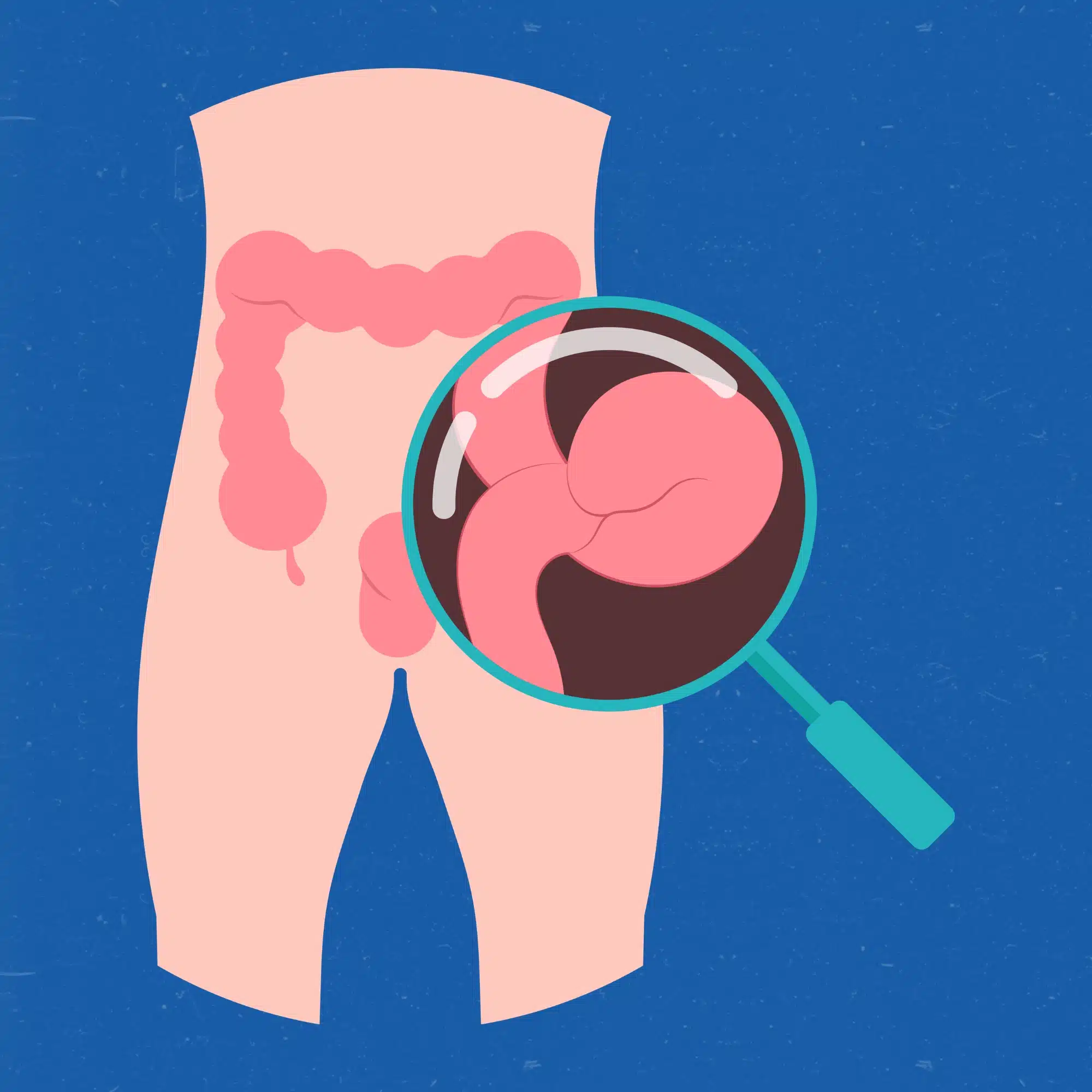 hernias