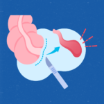 apendicitis