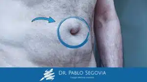 ¿Cómo saber si tengo una hernia?