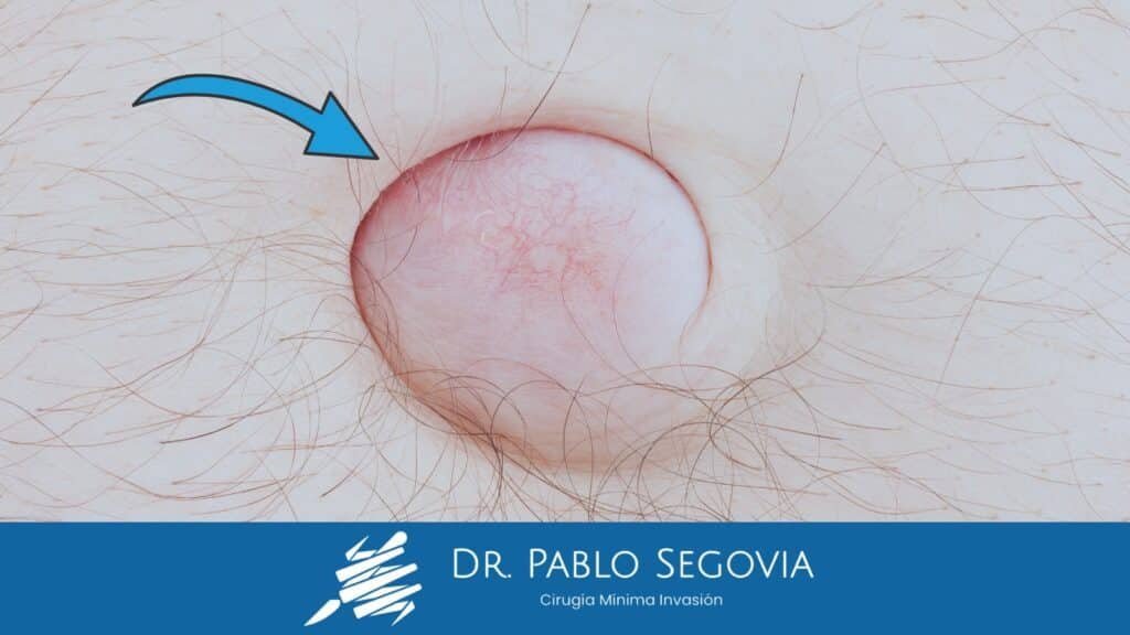 Hernia Abdominal: Tipos, Síntomas y Cuándo Es Necesario Operar hernia inguinal 3
