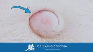 Hernia Abdominal: Tipos, Síntomas y Cuándo Es Necesario Operar