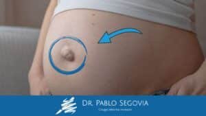 Hernia Umbilical en Adultos: Causas y Cirugía